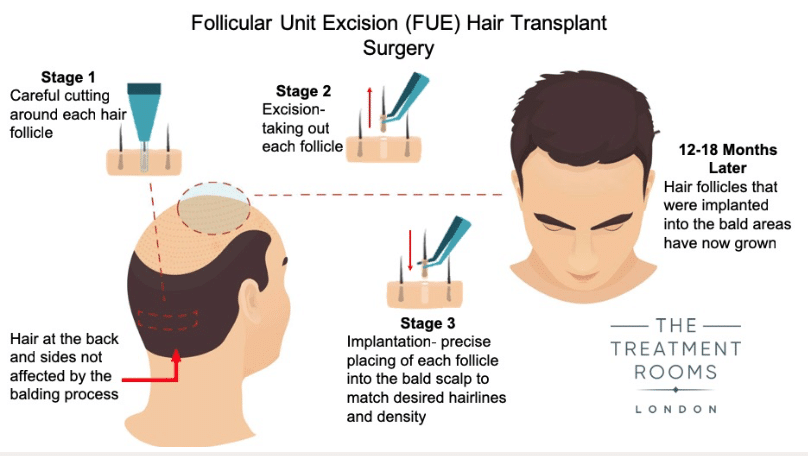 FUE Hair Transplant