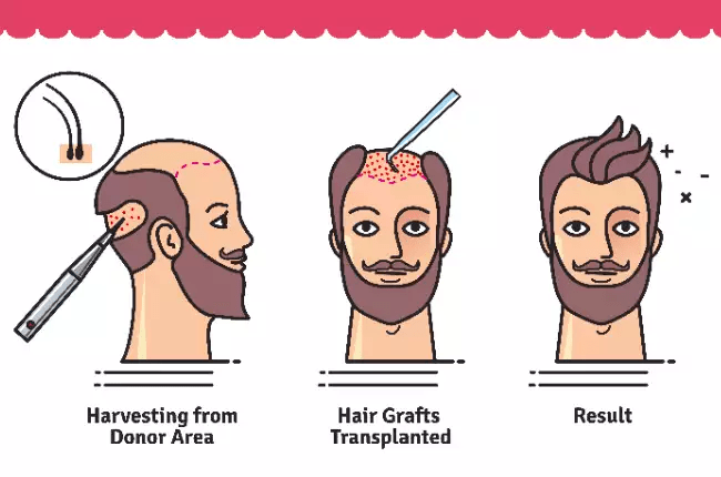 Hair Implant