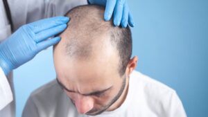 hair transplant in hyderabad